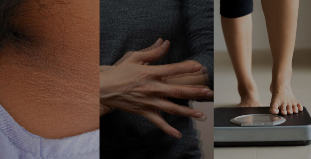 sintomas diabetes prediabetes